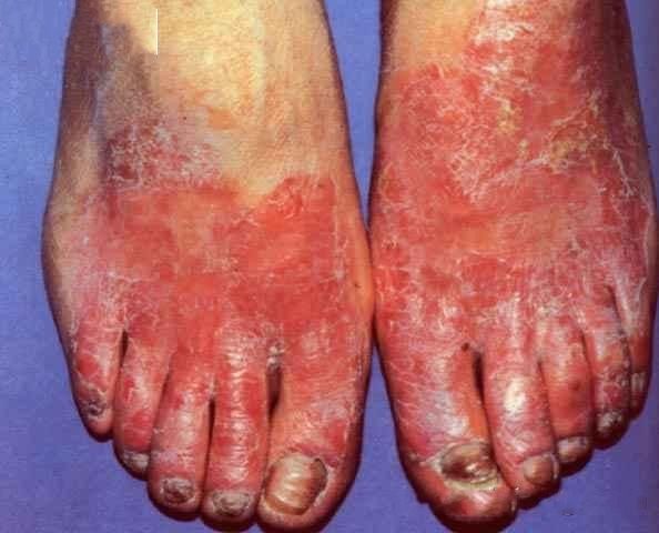 手足癣