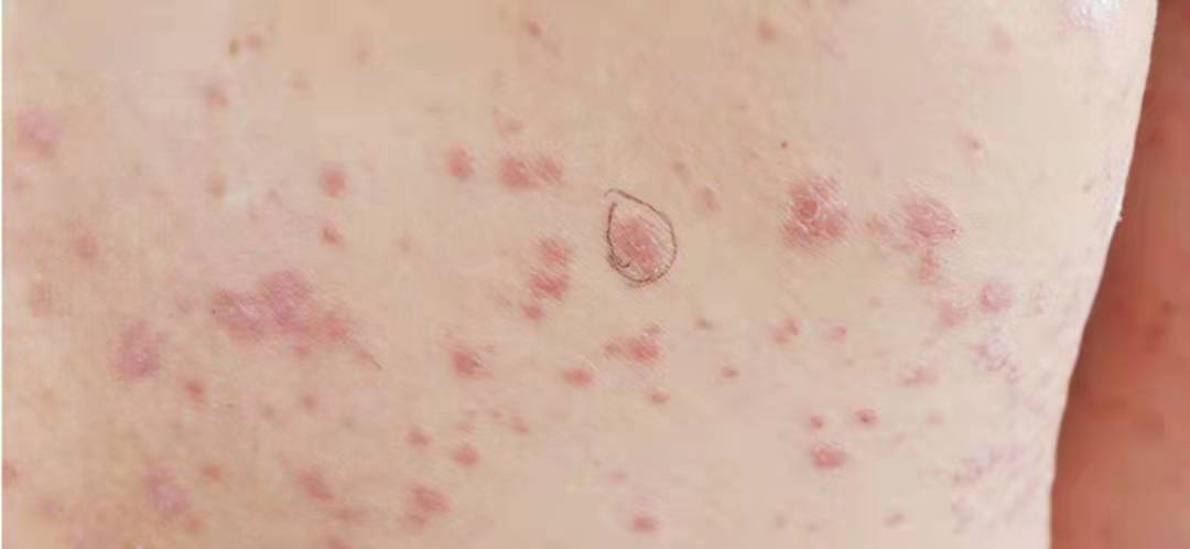 玫瑰糠疹