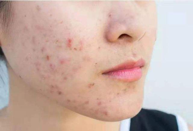 痤疮