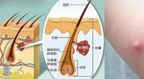 毛囊炎